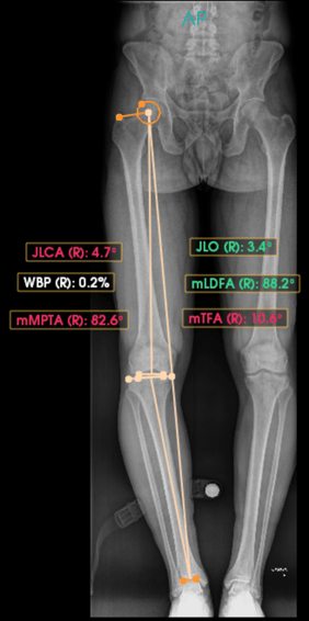 ゼロからはじめる!Knee Osteotomyアップデート ゼロからはじめる! Knee Osteotomyアップデート | 日本 Knee